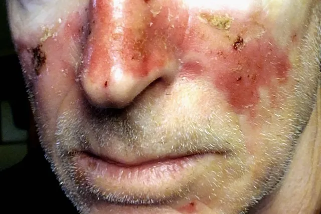 LES DANGERS DU SOLEIL EN THAILANDE